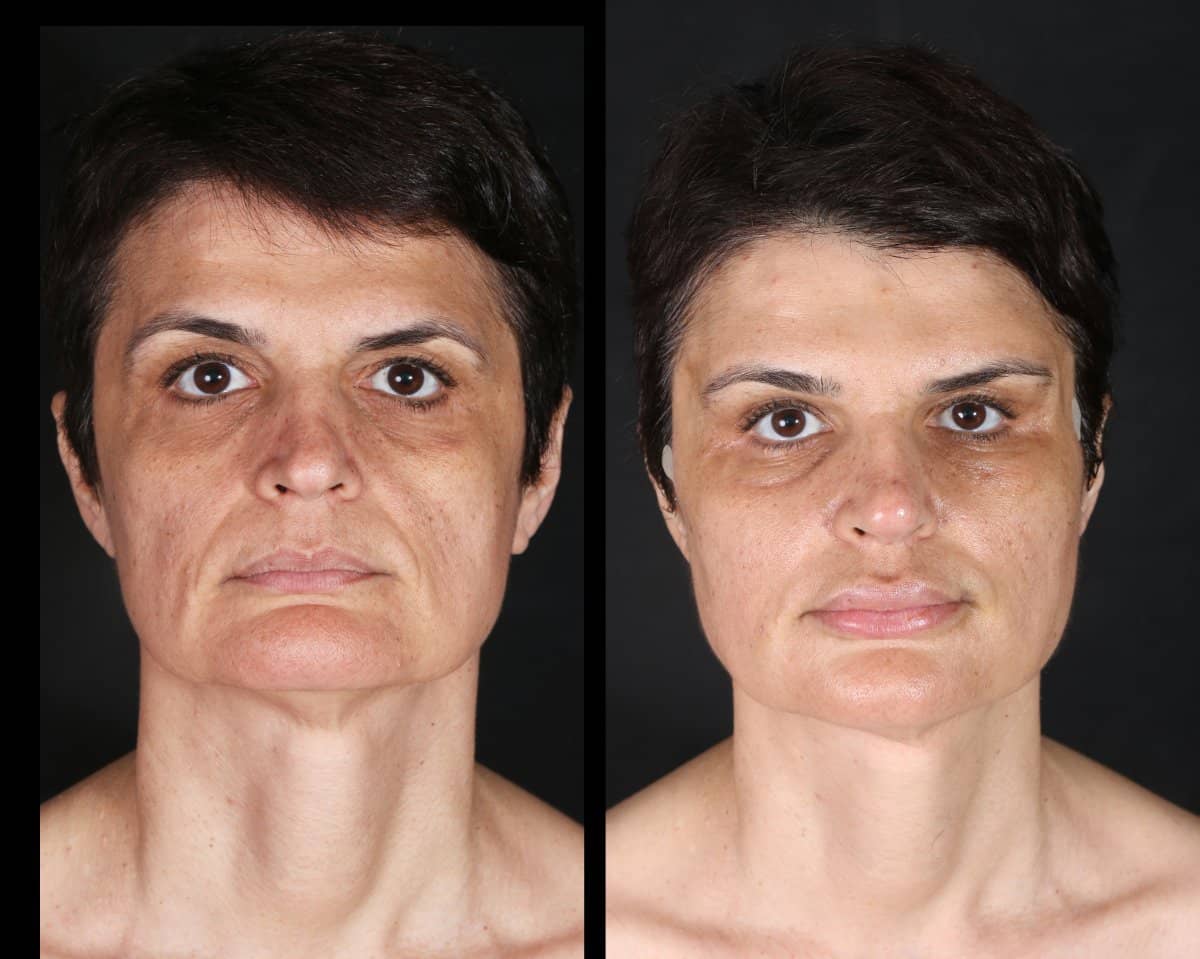 Case 12148 - facial fat transfer