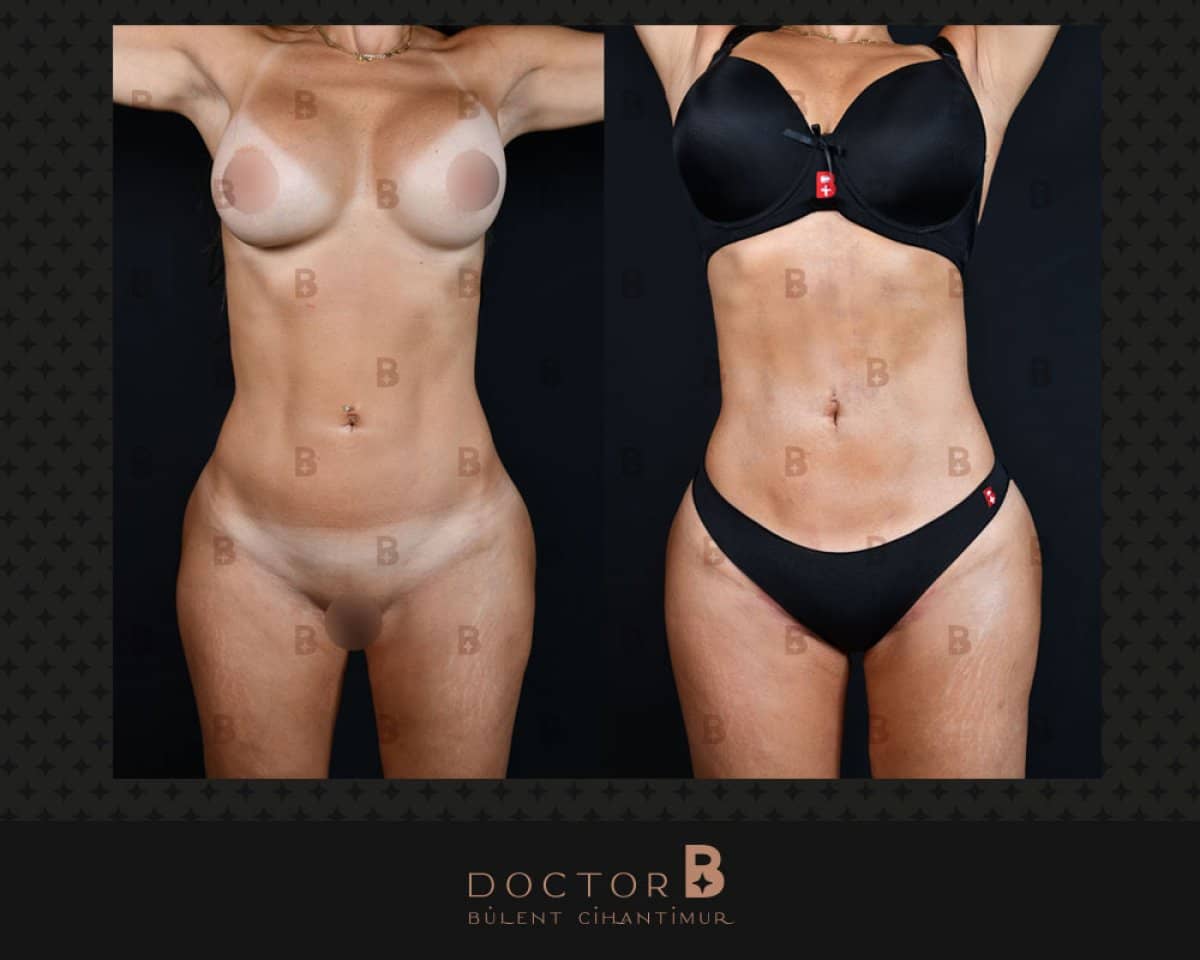Case 12150 - tummy tuck and liposuction