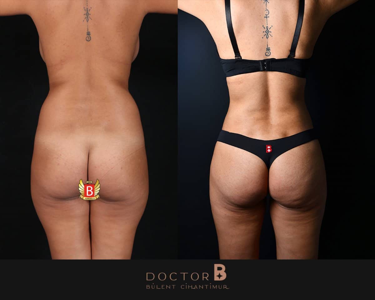Case 12153 - tummy tuck and liposuction