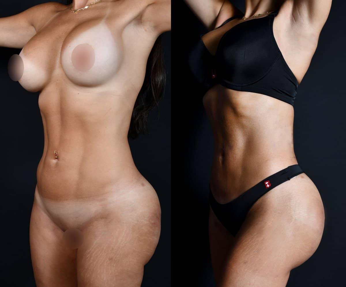 Case 12154 - tummy tuck and liposuction