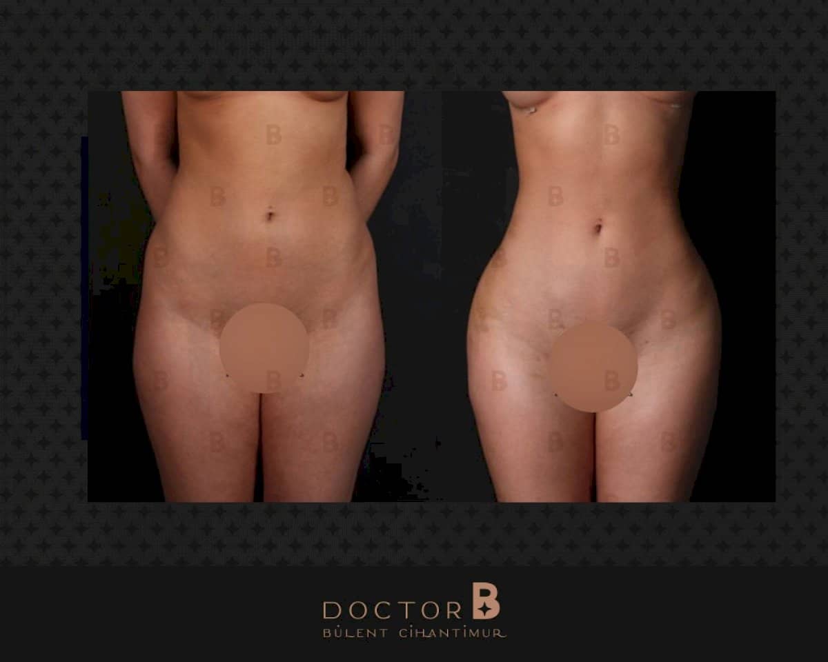 Case 12155 - liposuction
