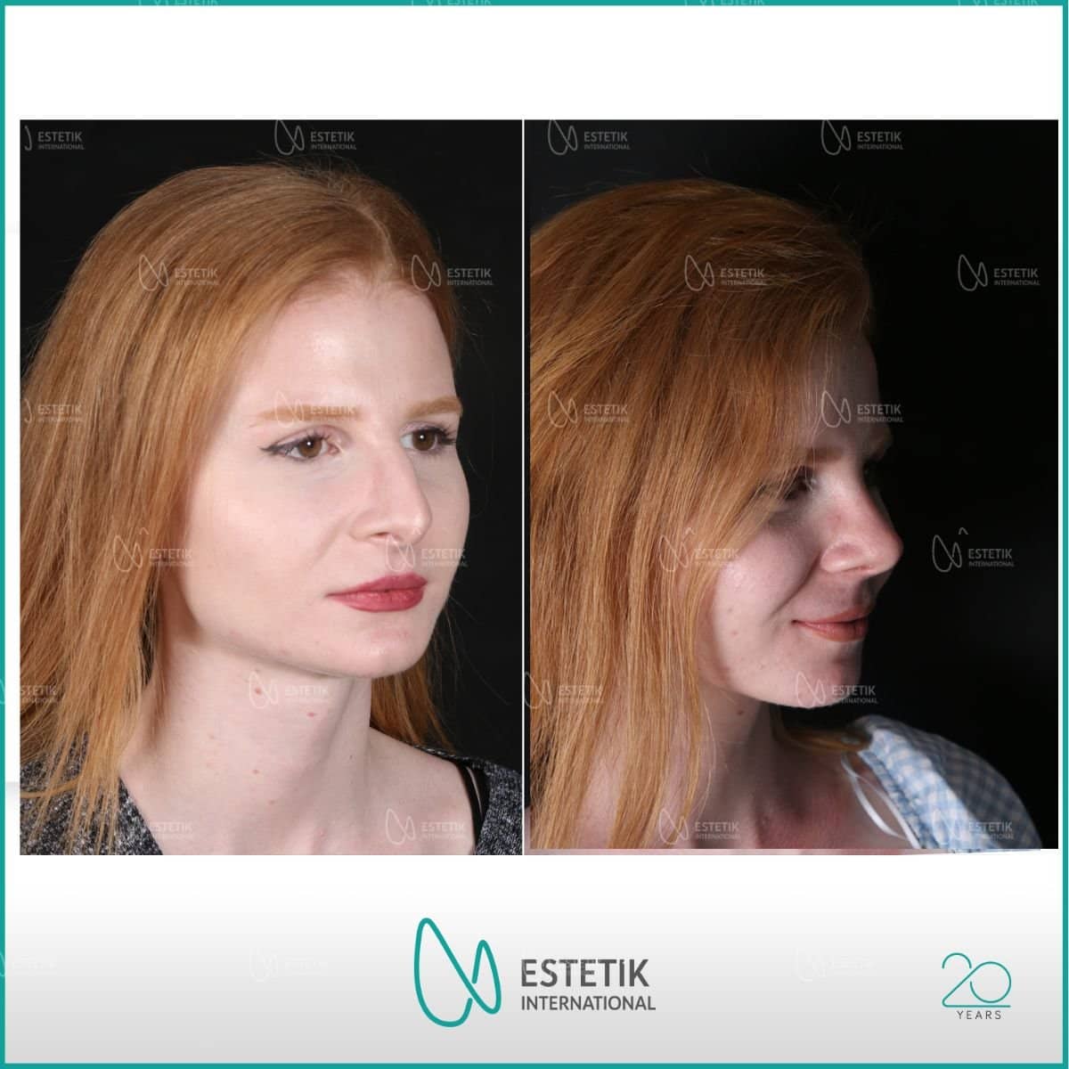 Case 12156 - rhinoplasty
