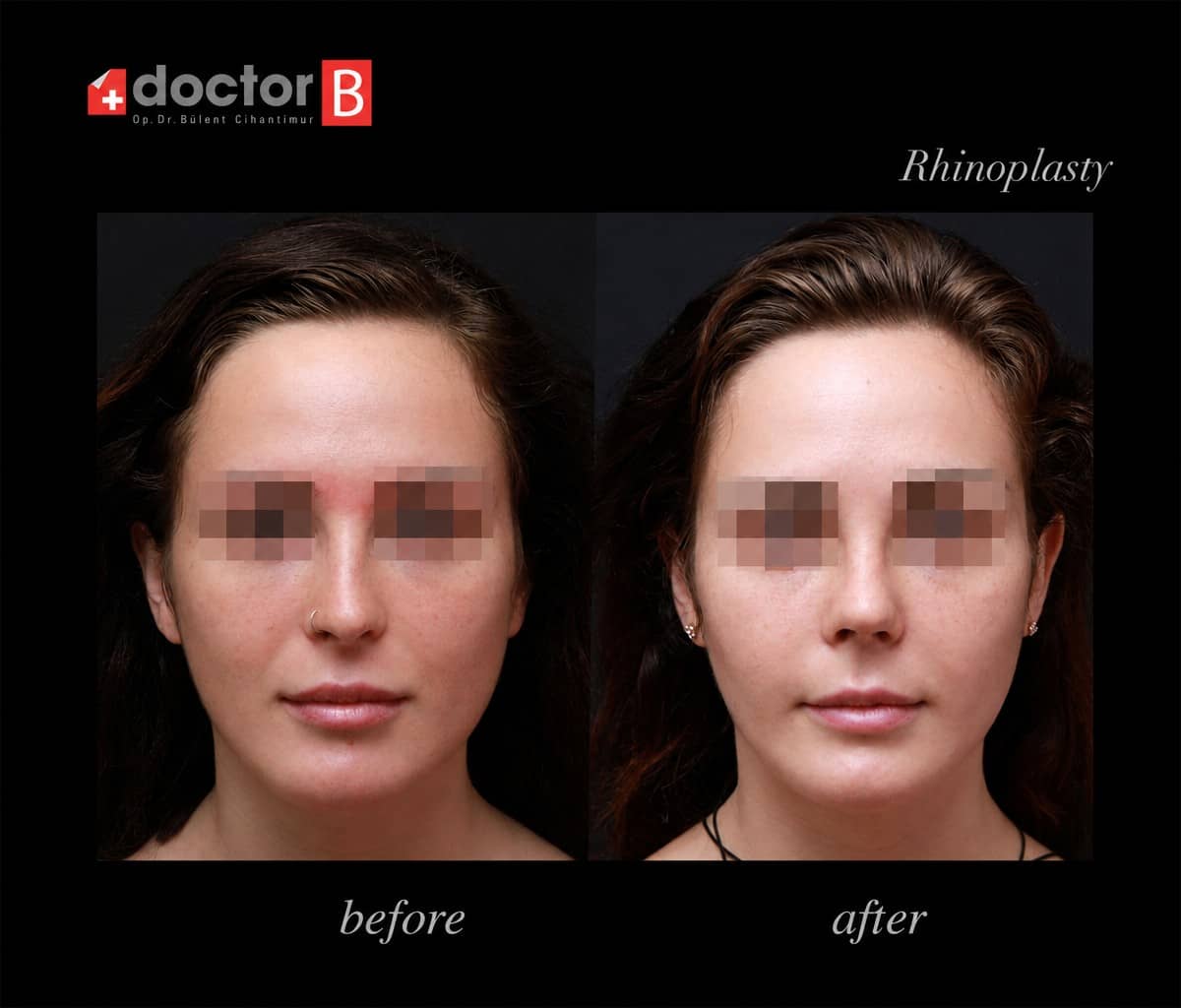 Case 12157 - rhinoplasty
