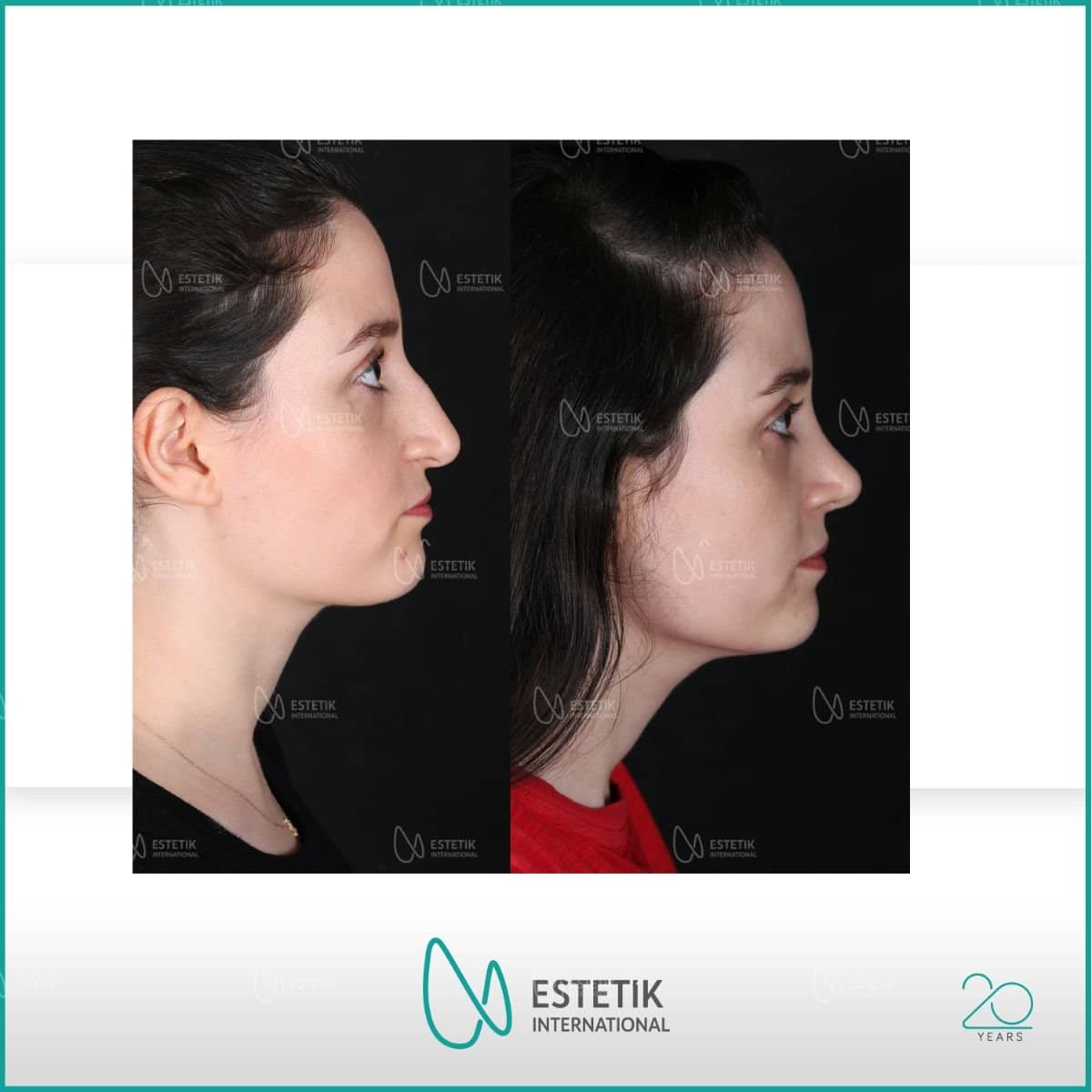 Case 12158 - rhinoplasty