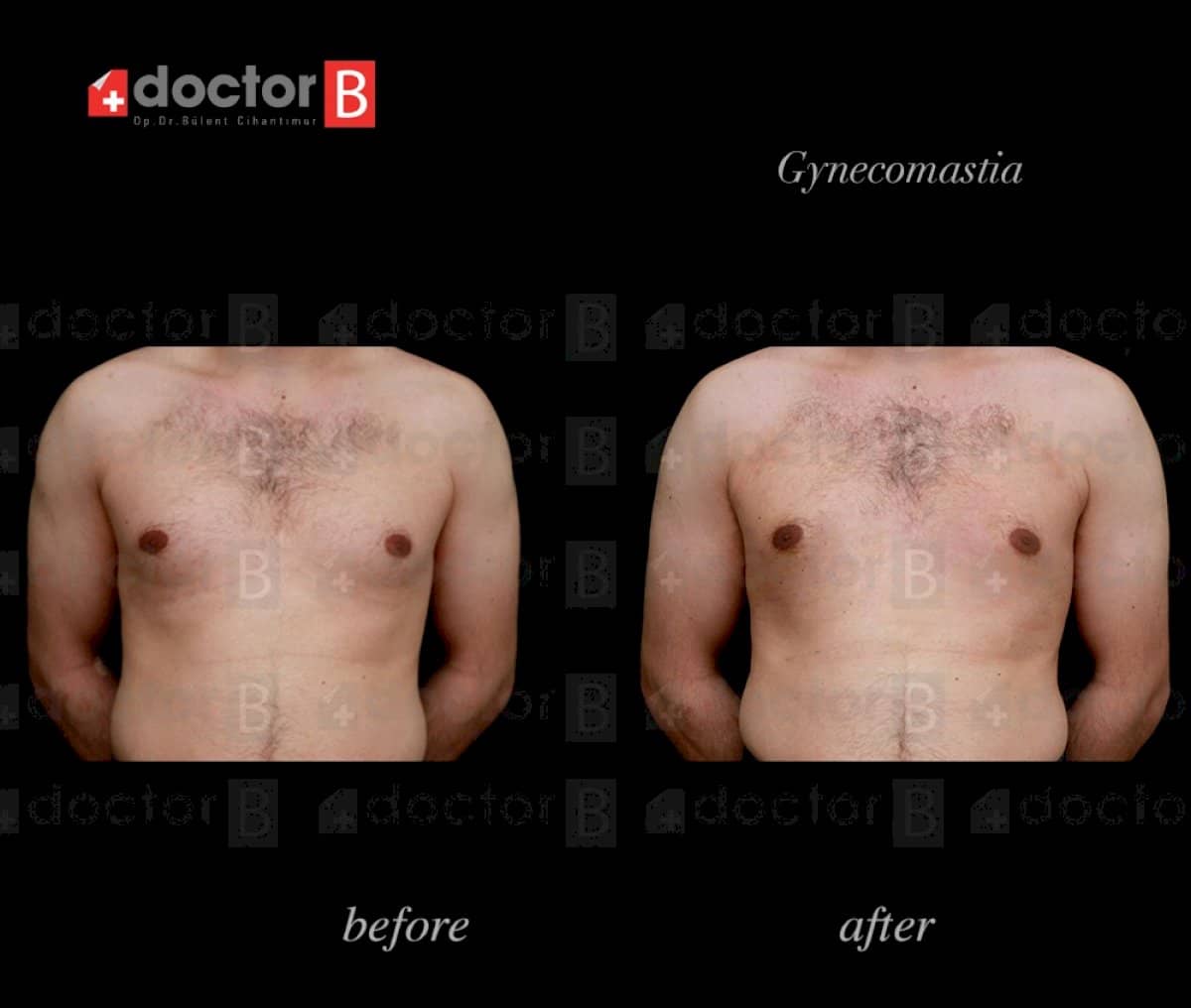 Case 12159 - gynecomastia surgery