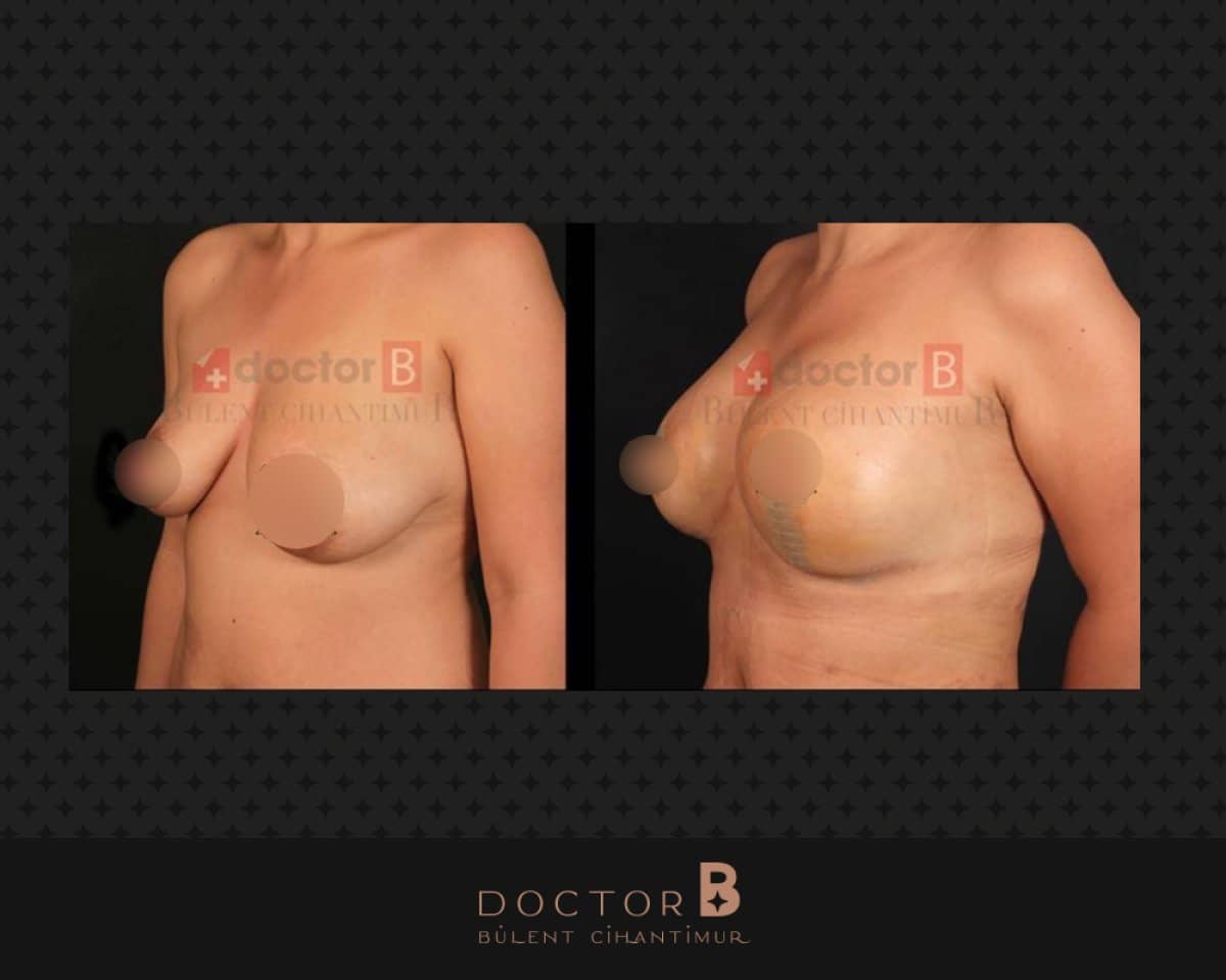 Case 12160 - breast implants with lift