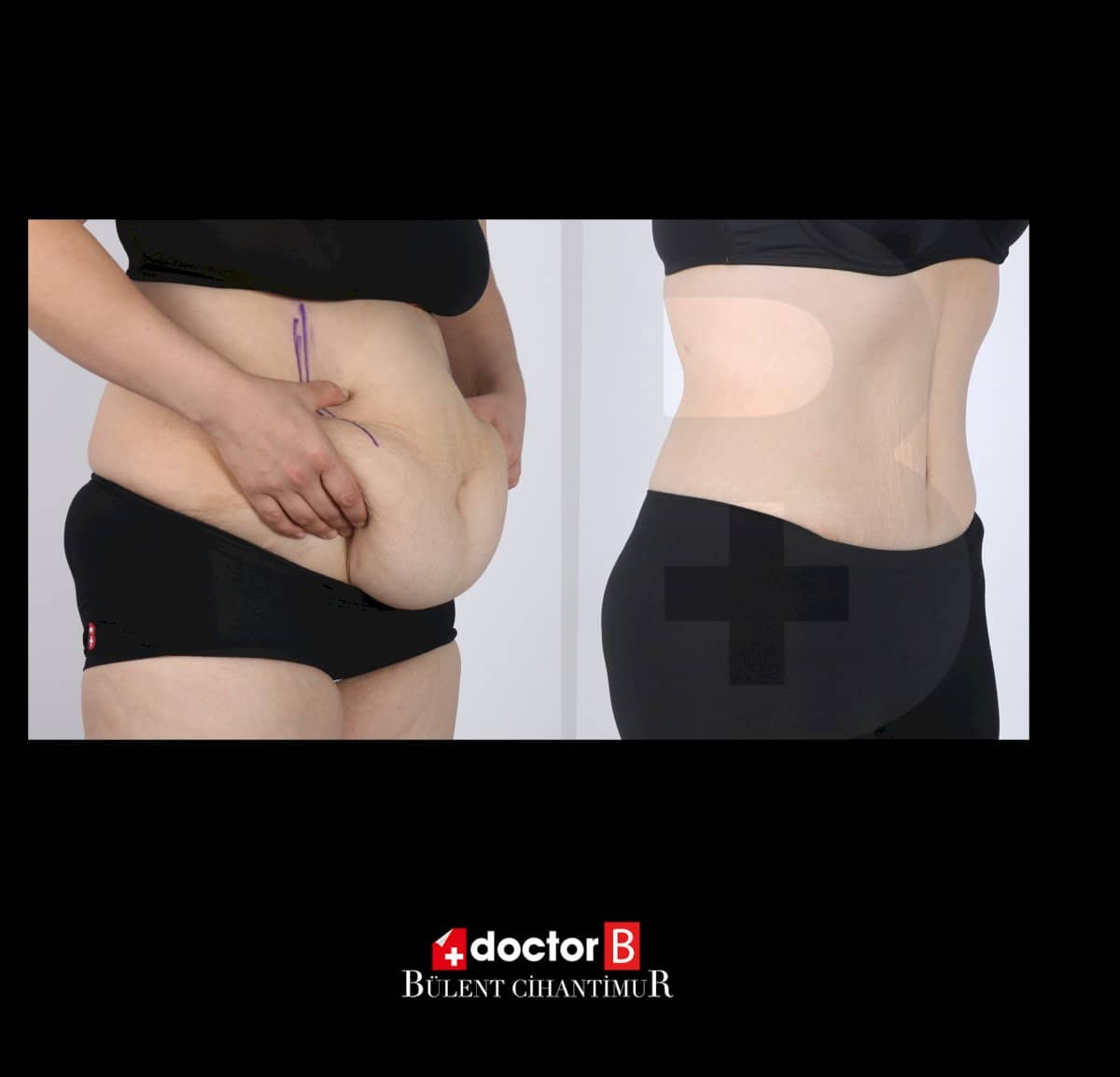 Case 12161 - tummy tuck and liposuction