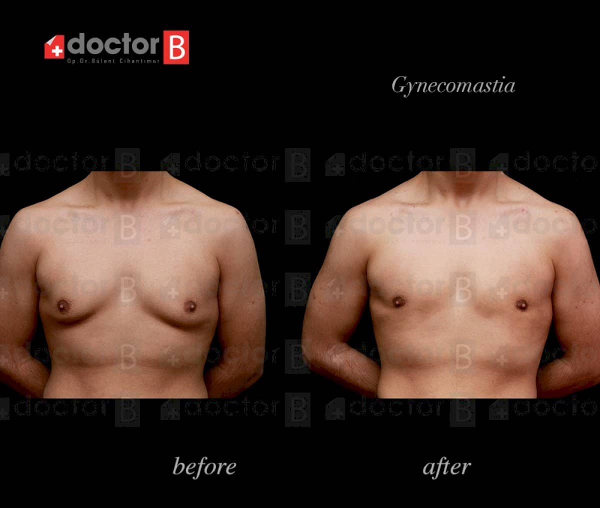 Case 12162 - gynecomastia surgery