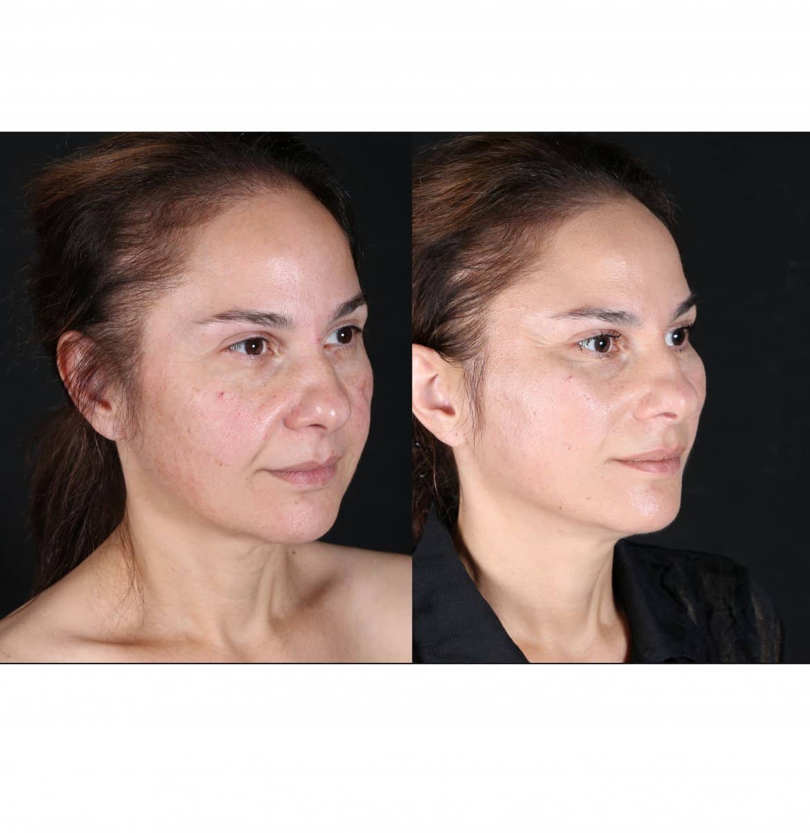 Case 12164 - facial fat transfer