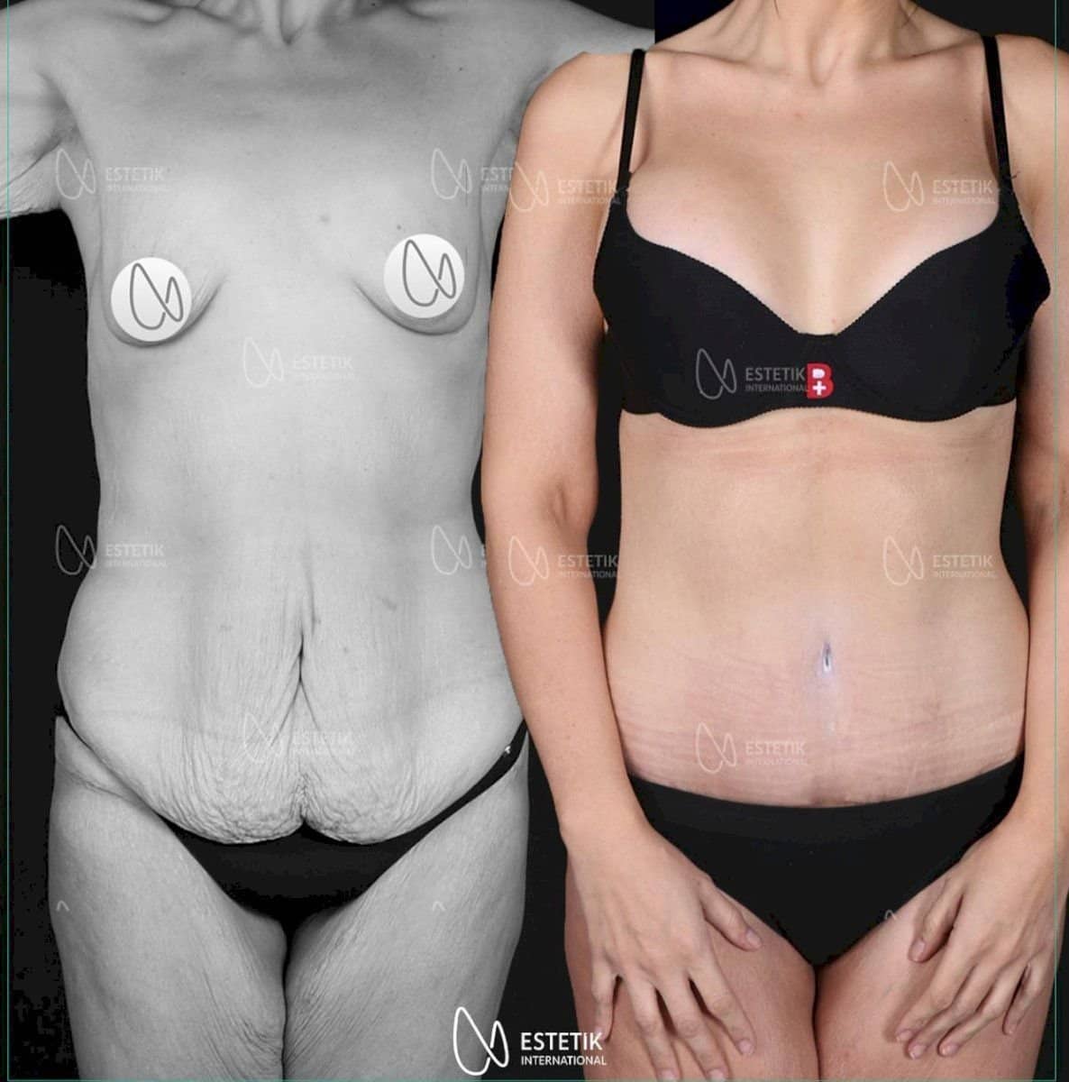 Case 12165 - tummy tuck and liposuction