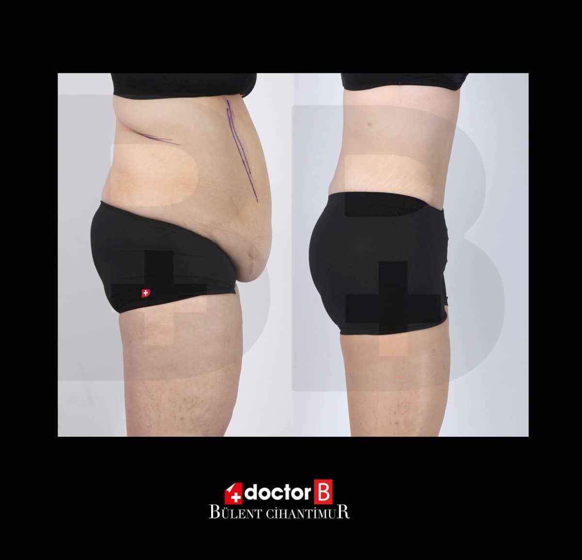 Case 12167 - tummy tuck