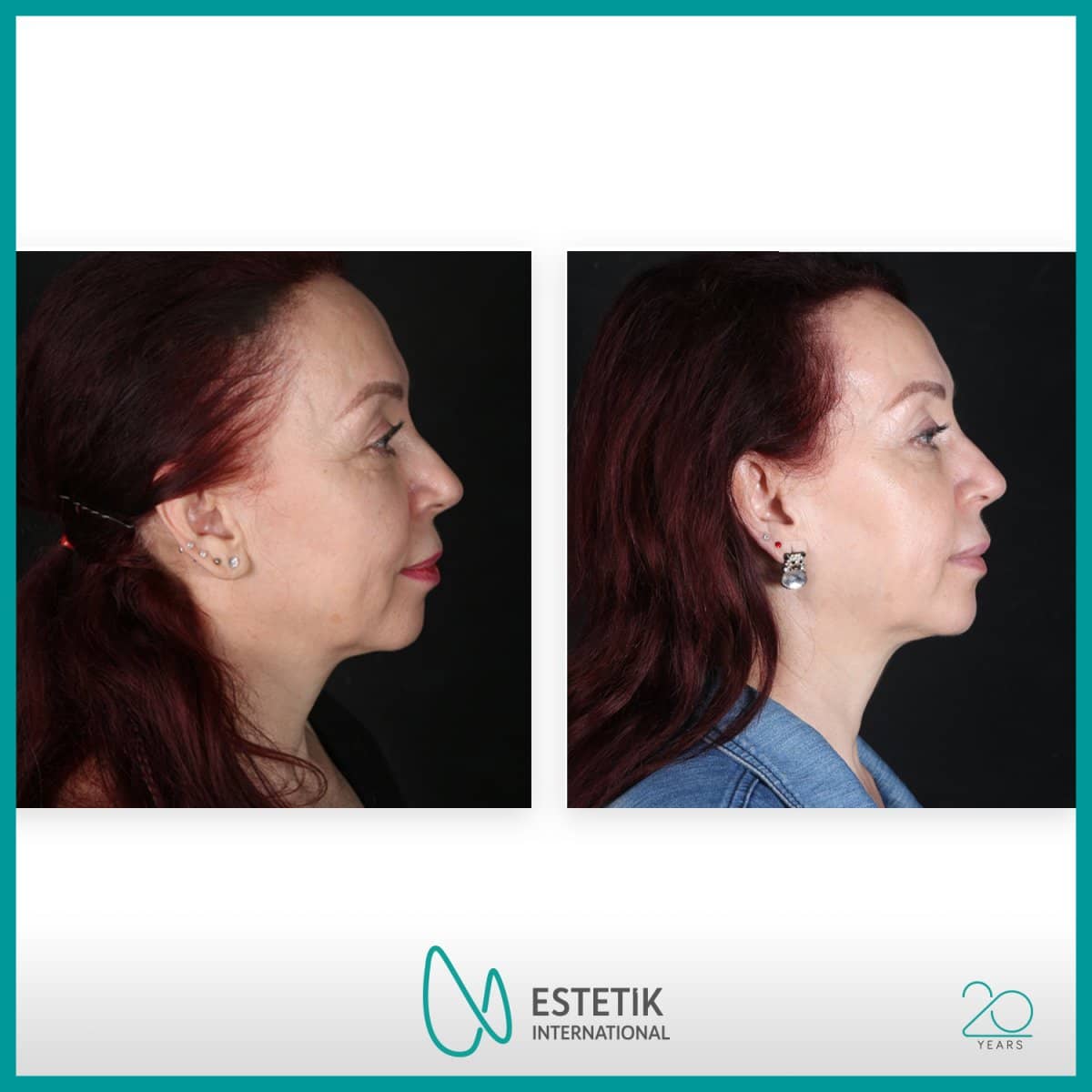 Case 12169 - facial fat transfer