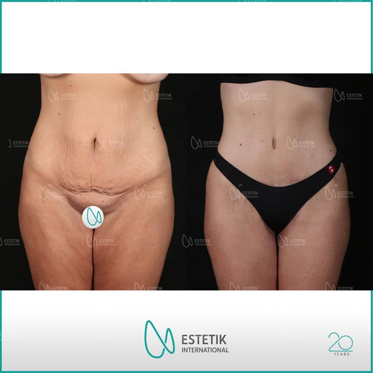 Case 12173 - tummy tuck and liposuction