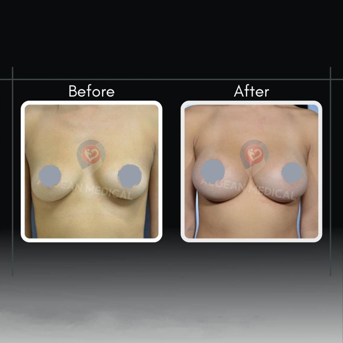 Case 12179 - breast augmentation