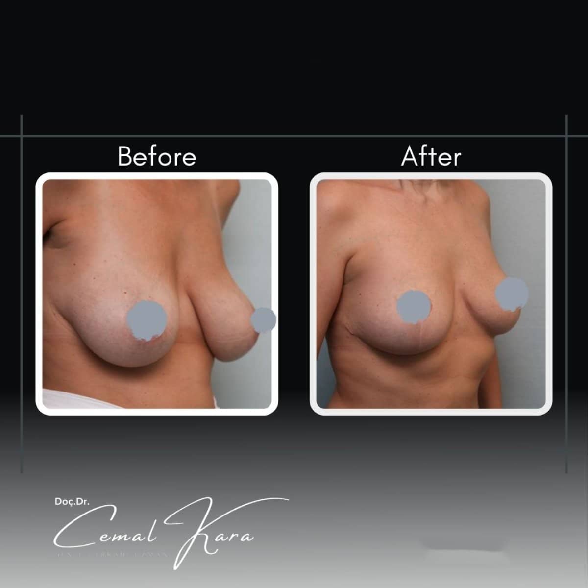 Case 12181 - breast reduction