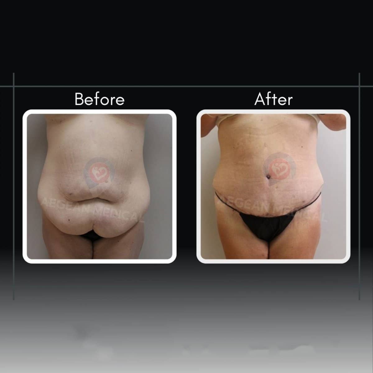 Case 12182 - tummy tuck