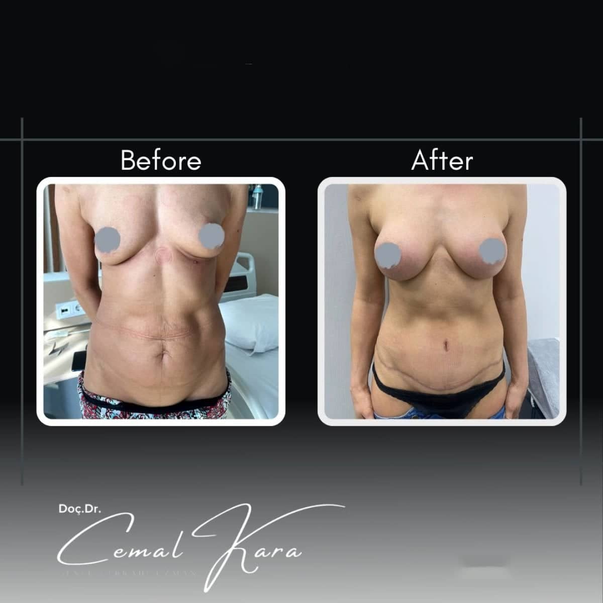 Case 12183 - breast augmentation