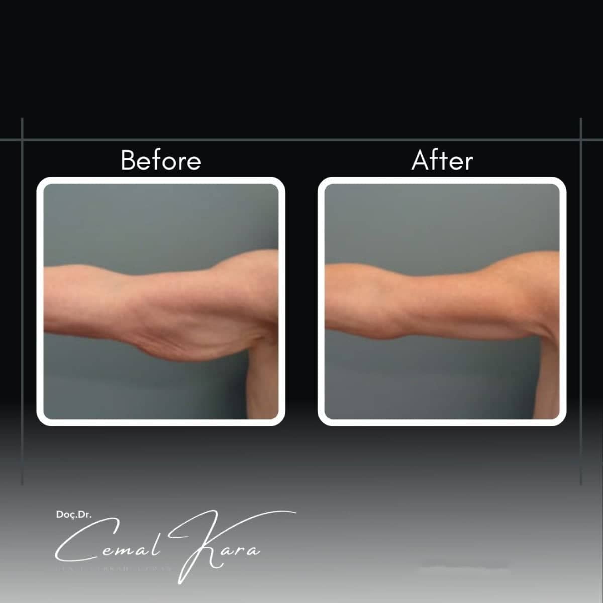 Case 12184 - arm liposuction
