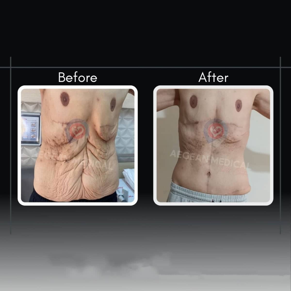 Case 12185 - tummy tuck and liposuction