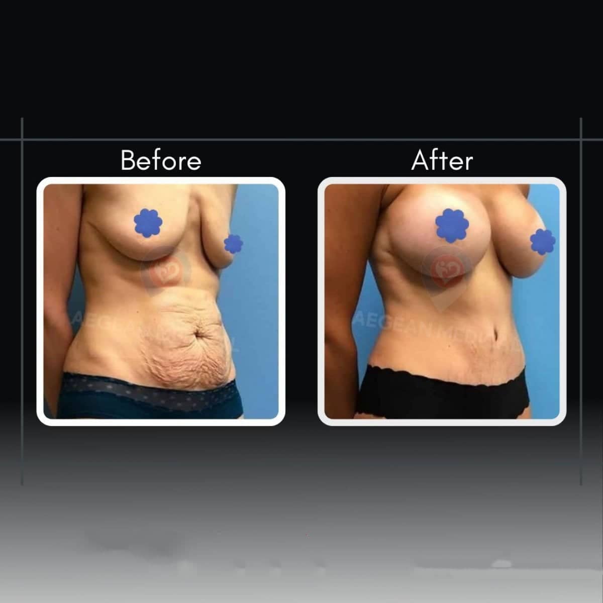 Case 12186 - breast augmentation and tummy tuck