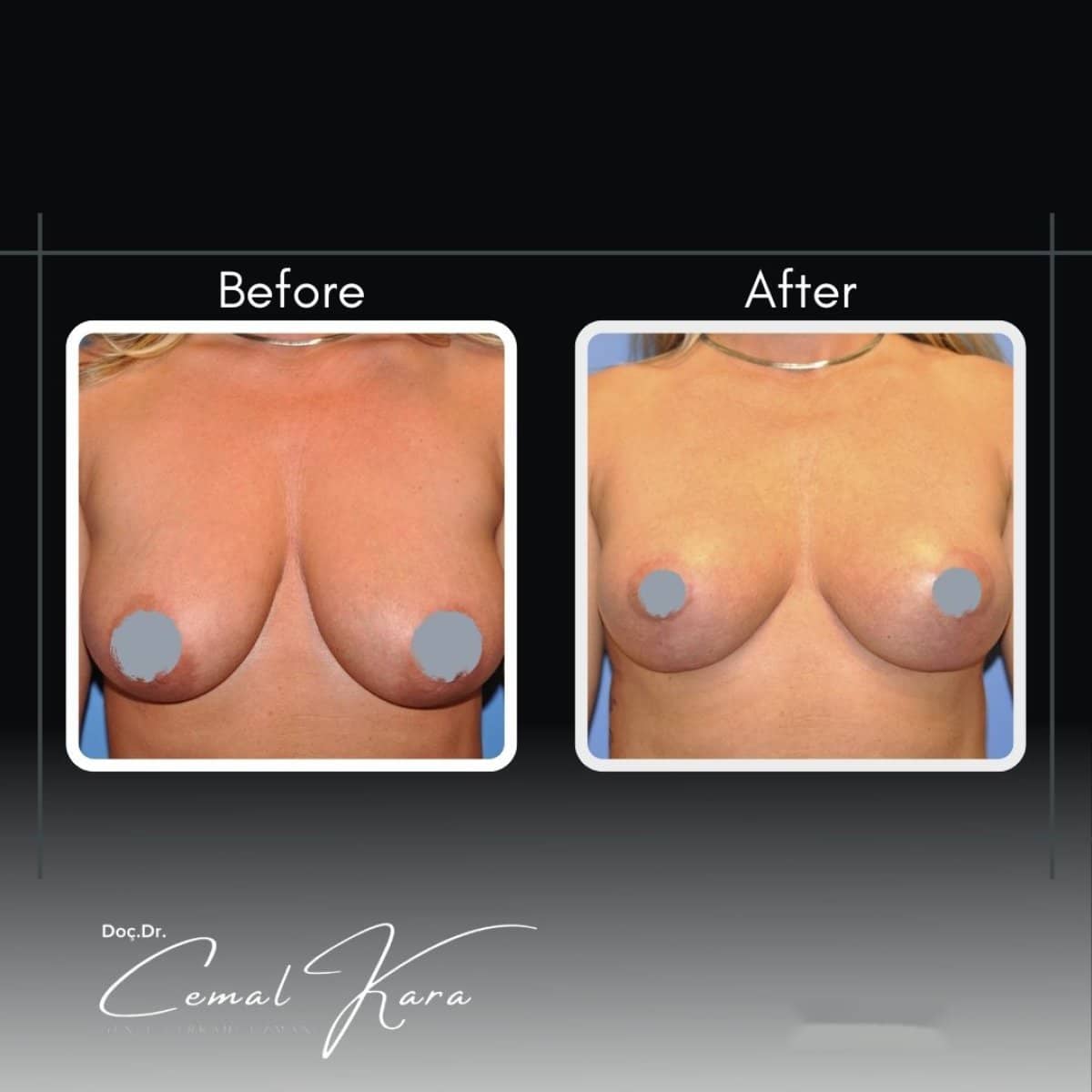 Case 12187 - breast reduction