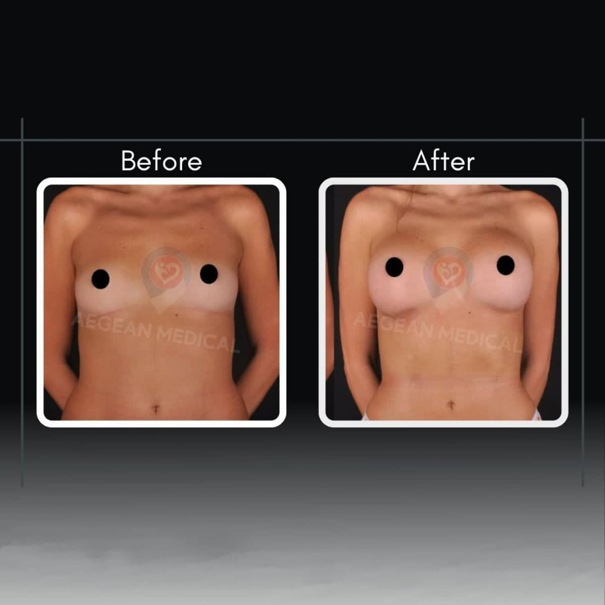 Case 12188 - breast augmentation