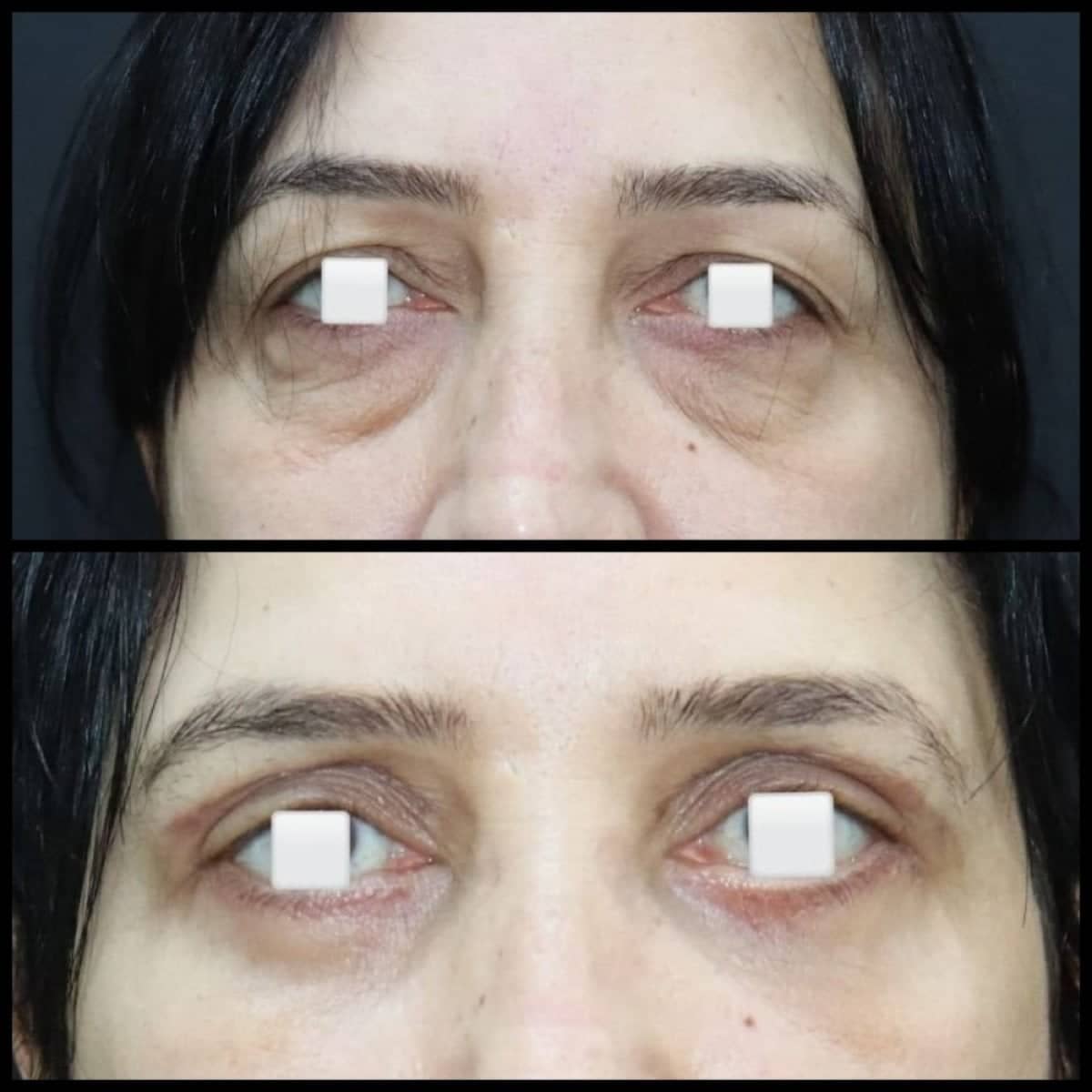 Case 12190 - blepharoplasty