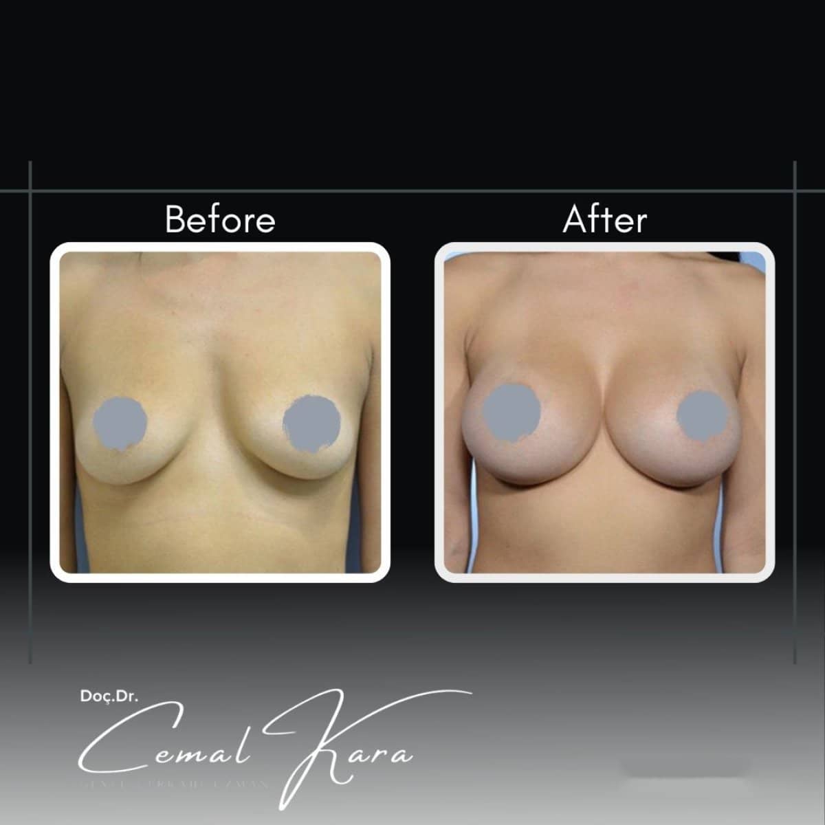 Case 12191 - breast augmentation