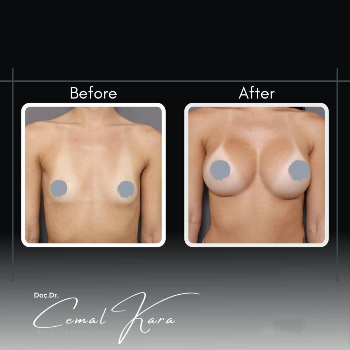 Case 12194 - breast augmentation