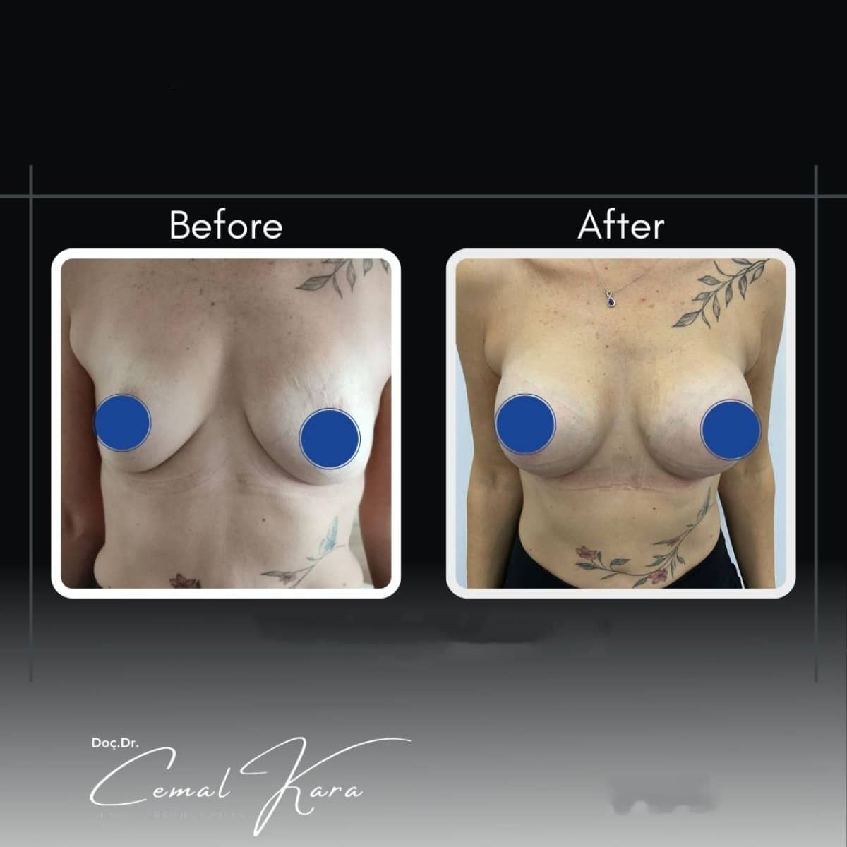 Case 12197 - breast augmentation