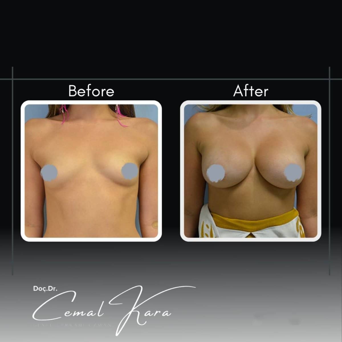 Case 12199 - breast augmentation