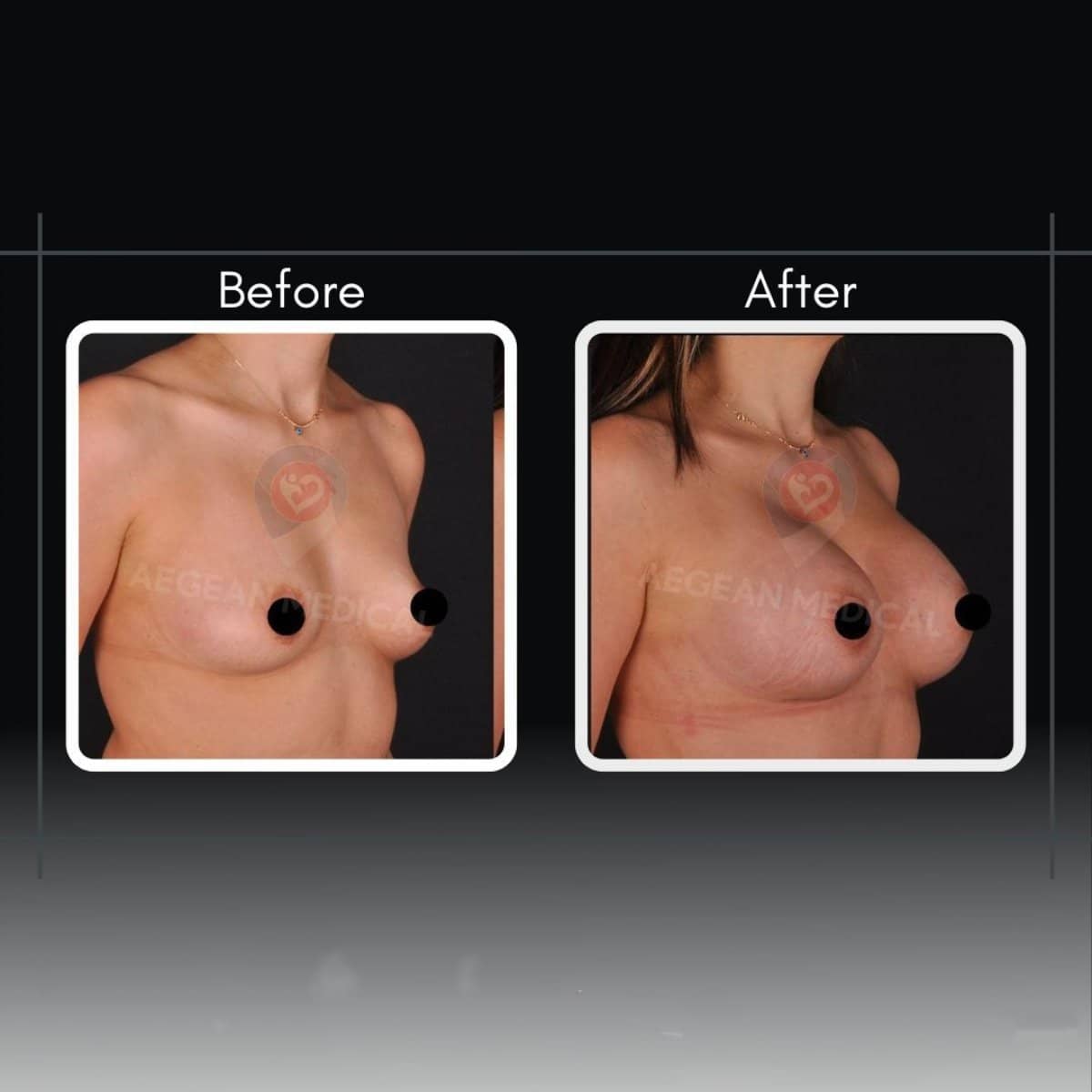 Case 12200 - breast augmentation