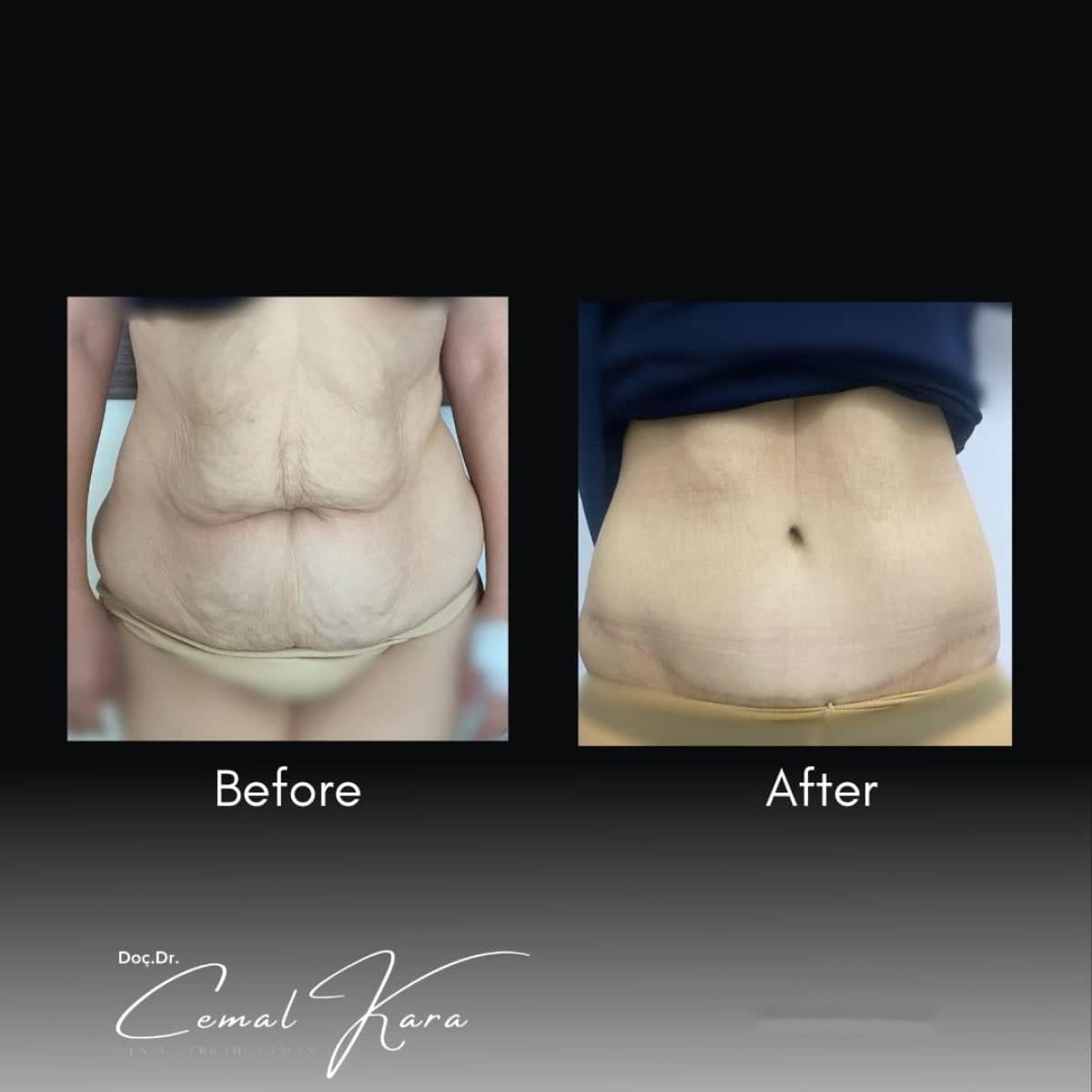 Case 12201 - liposuction