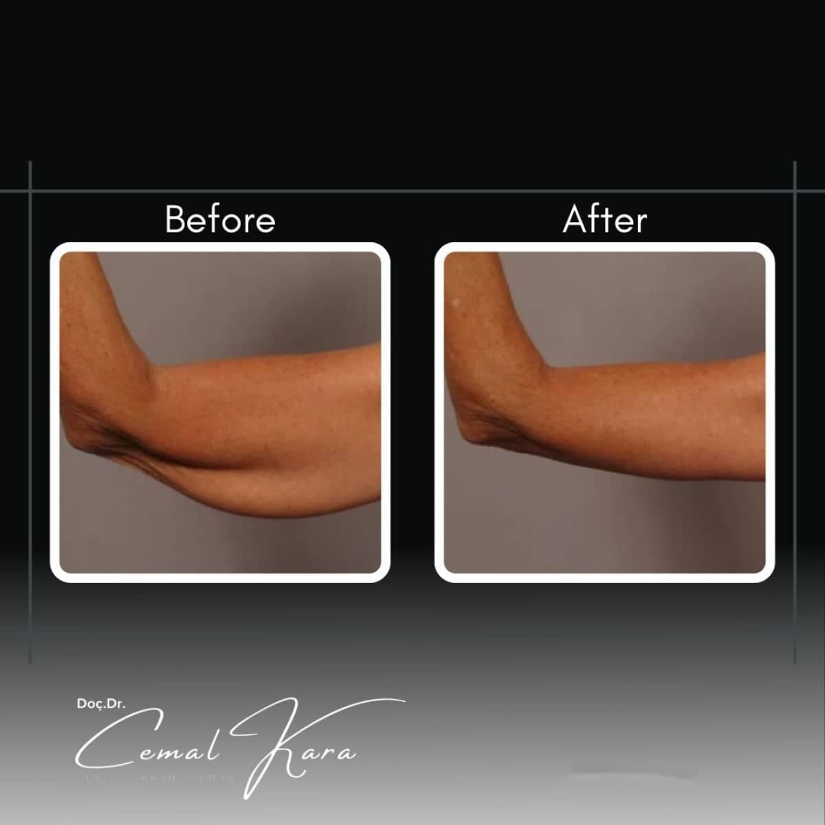 Case 12202 - arm liposuction