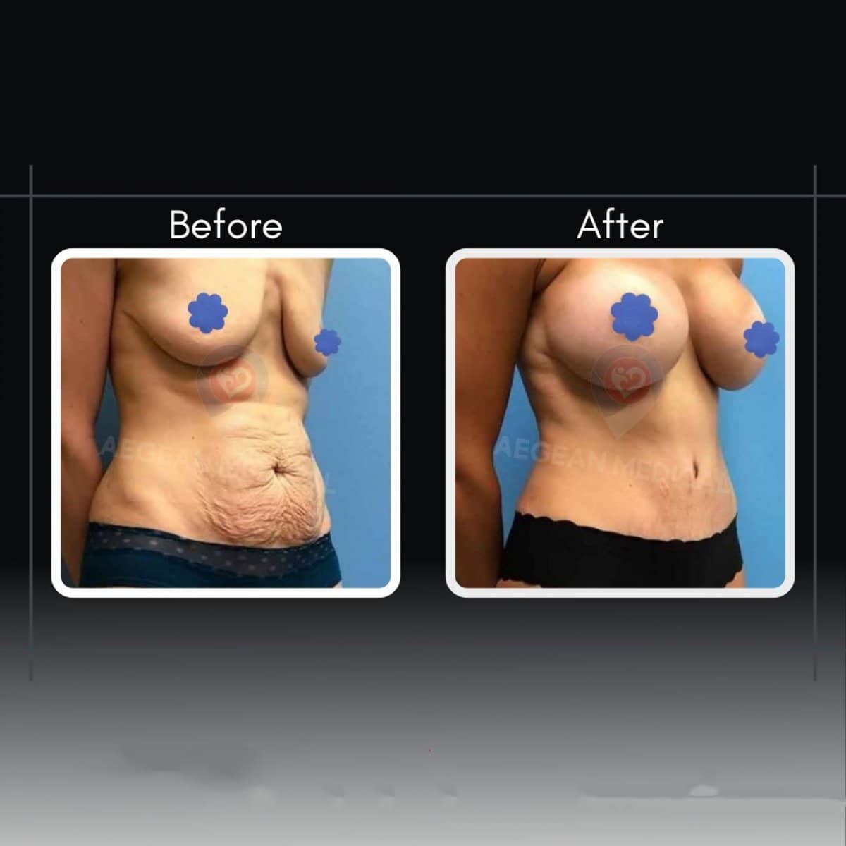 Case 12203 - tummy tuck