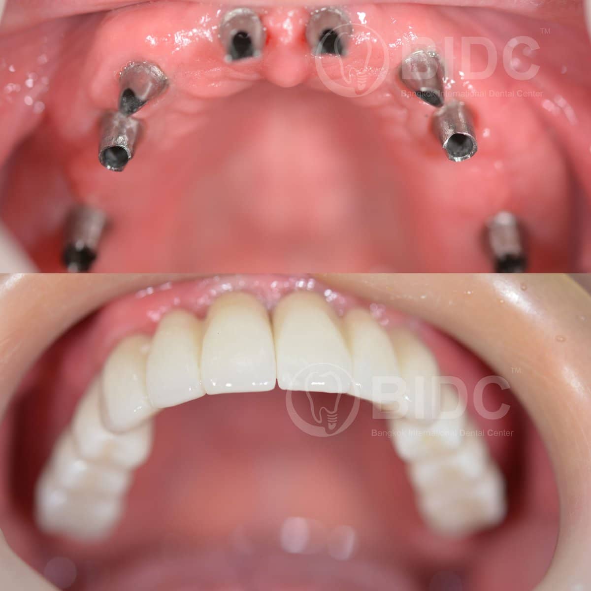 Case 12209 - All-on-6 dental implants