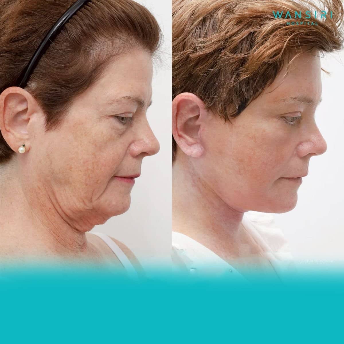 Case 12211 - deep plane facelift