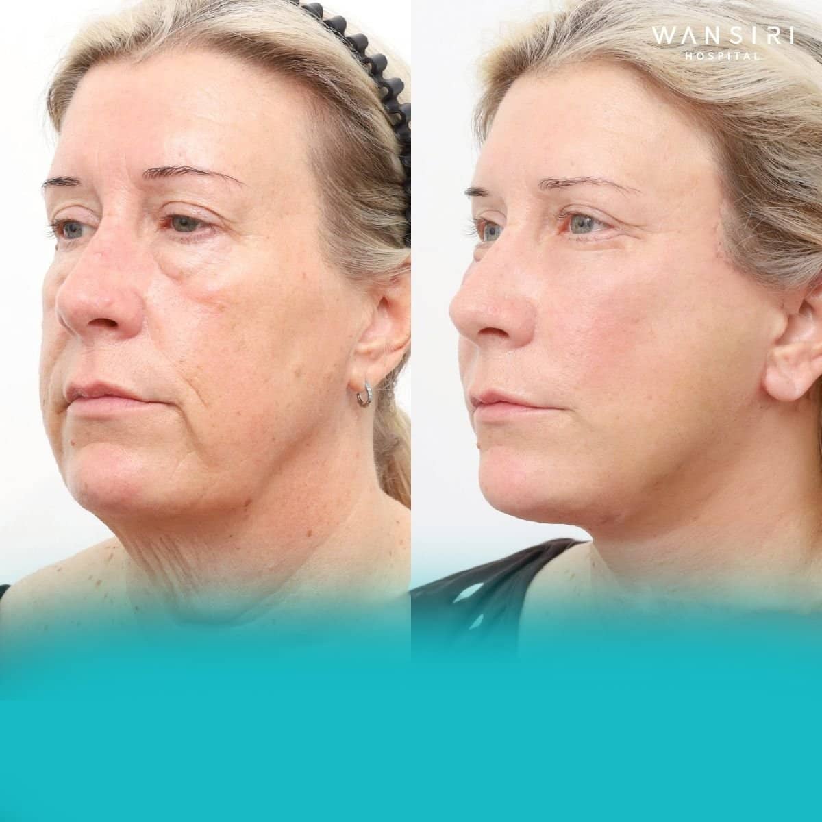 Case 12212 - fillers injection