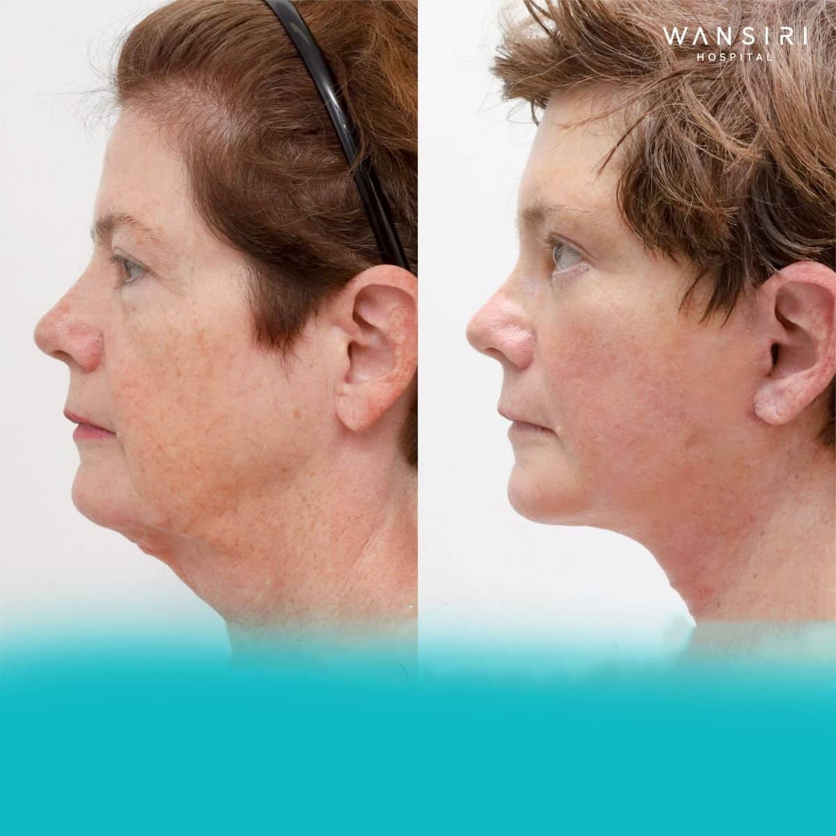 Case 12214 - facelift