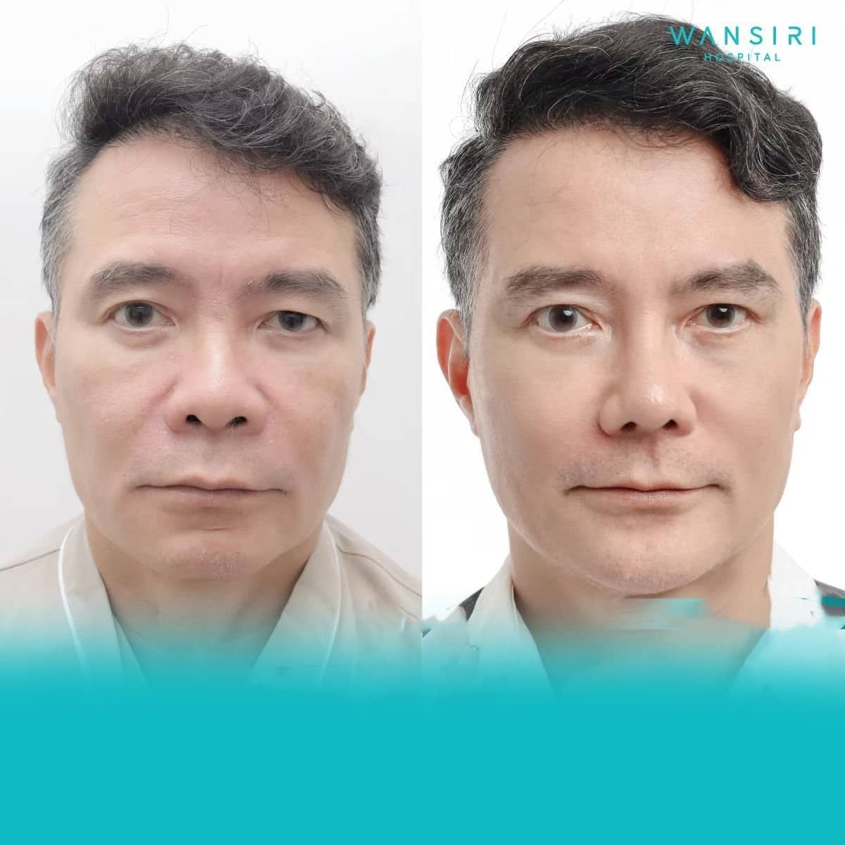 Case 12215 - facelift