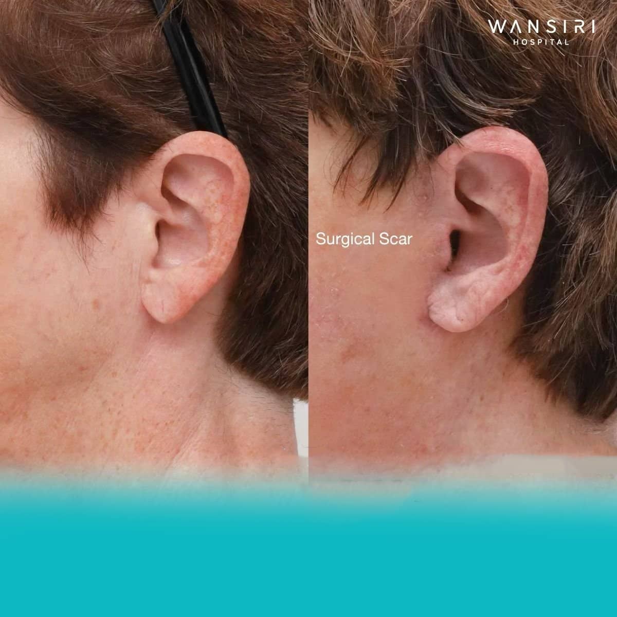 Case 12216 - deep plane facelift