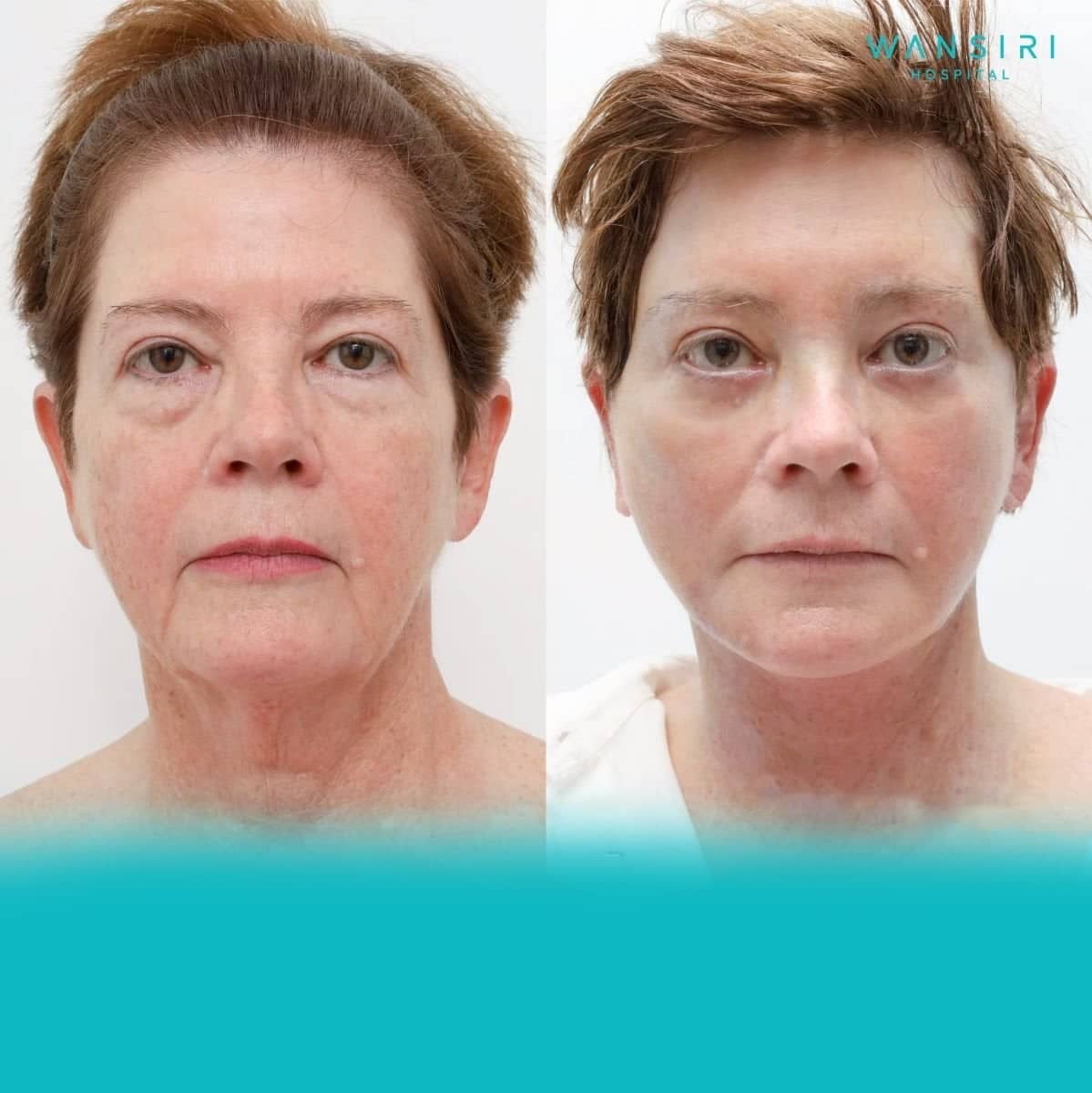 Case 12218 - deep plane facelift