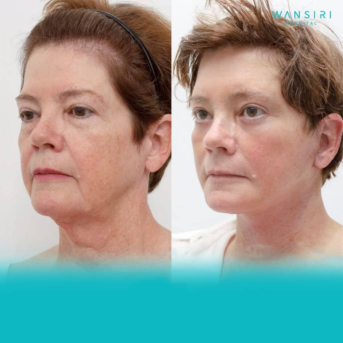 Case 12219 - deep plane facelift