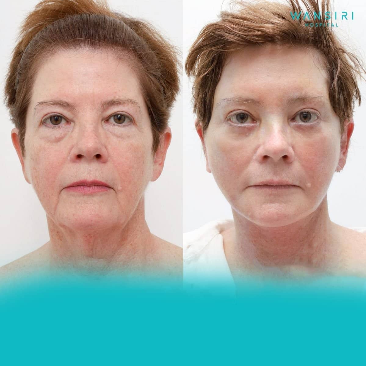 Case 12223 - facelift
