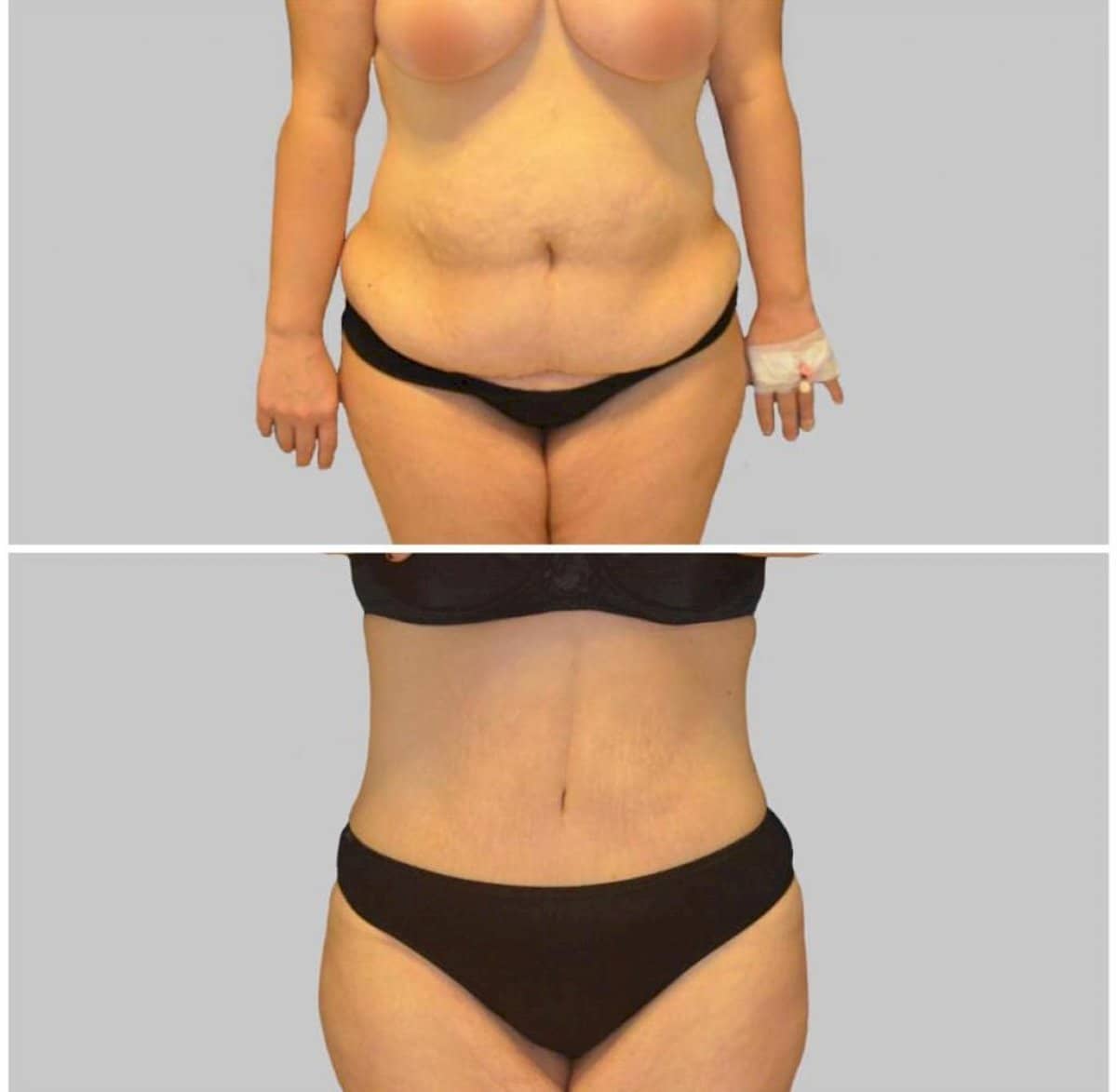Case 12230 - tummy tuck