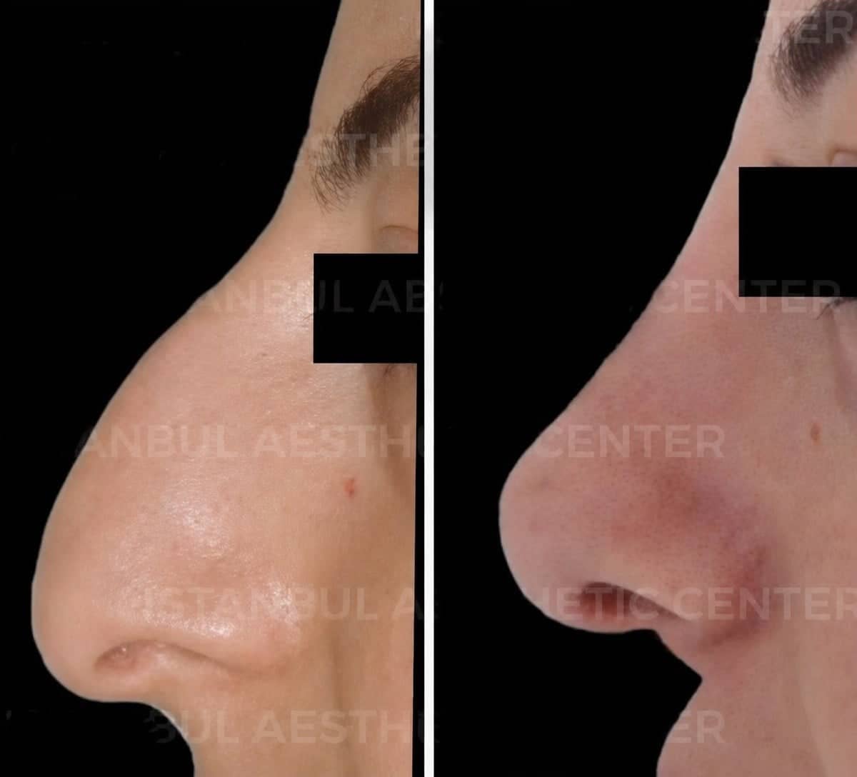 Case 12231 - rhinoplasty