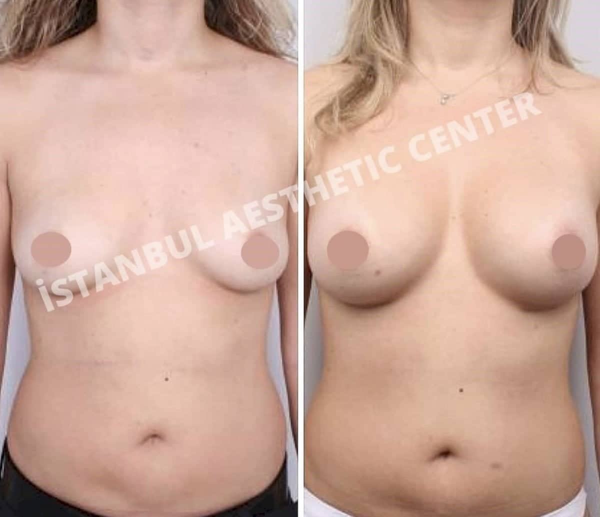 Case 12232 - mammoplasty