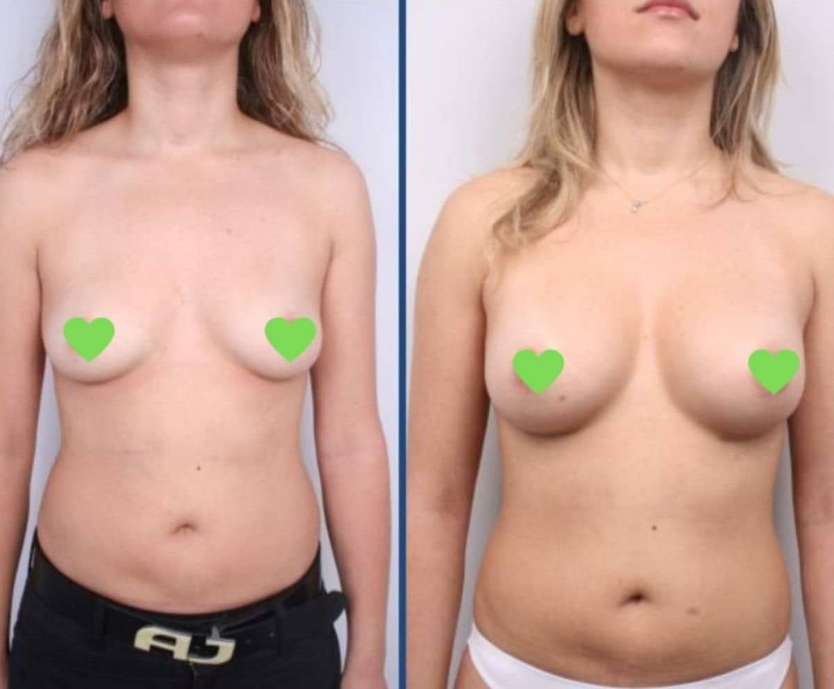 Case 12235 - breast implants with lift
