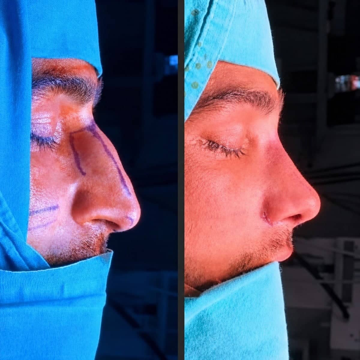 Case 12236 - septoplasty