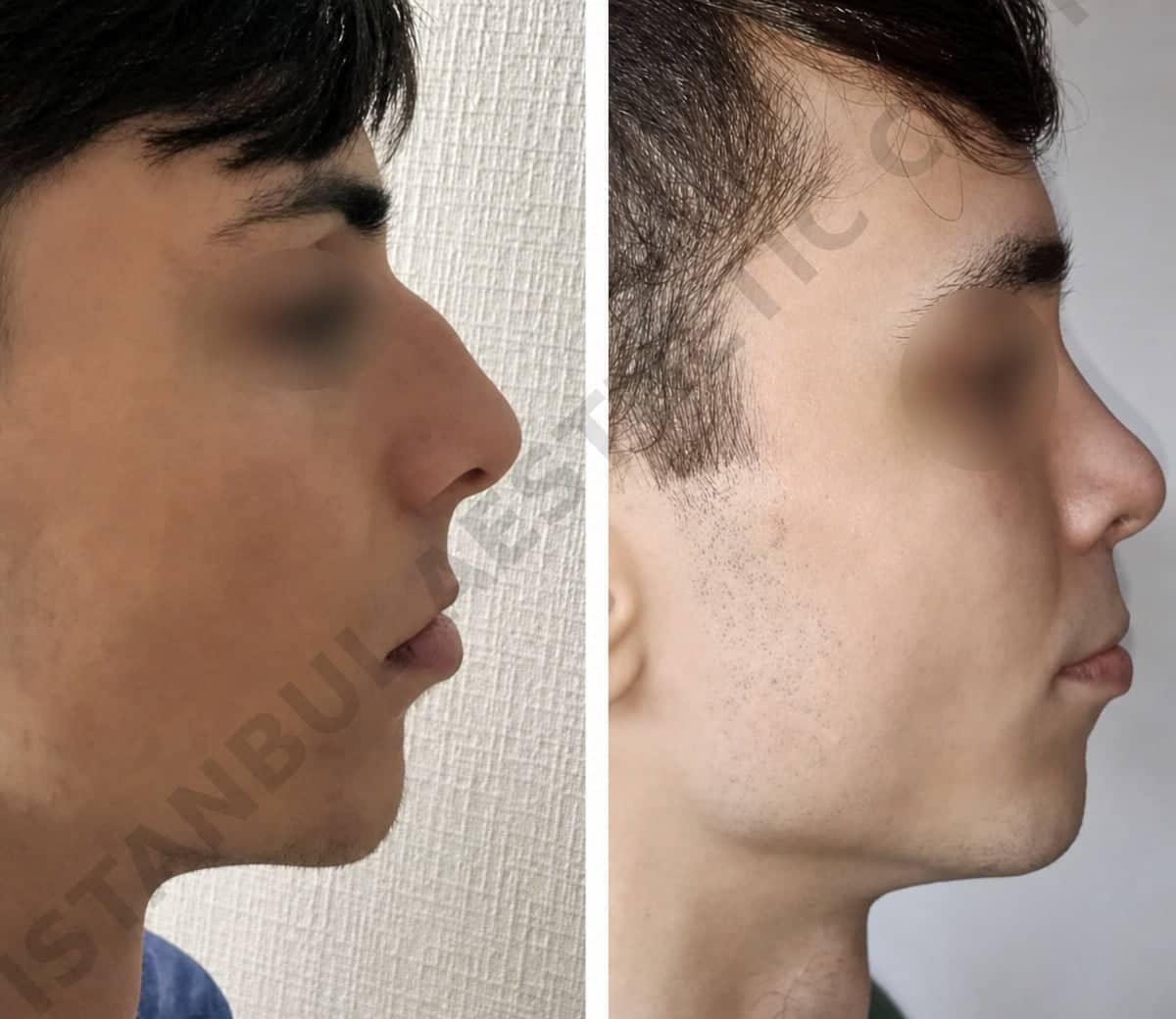 Case 12238 - rhinoplasty